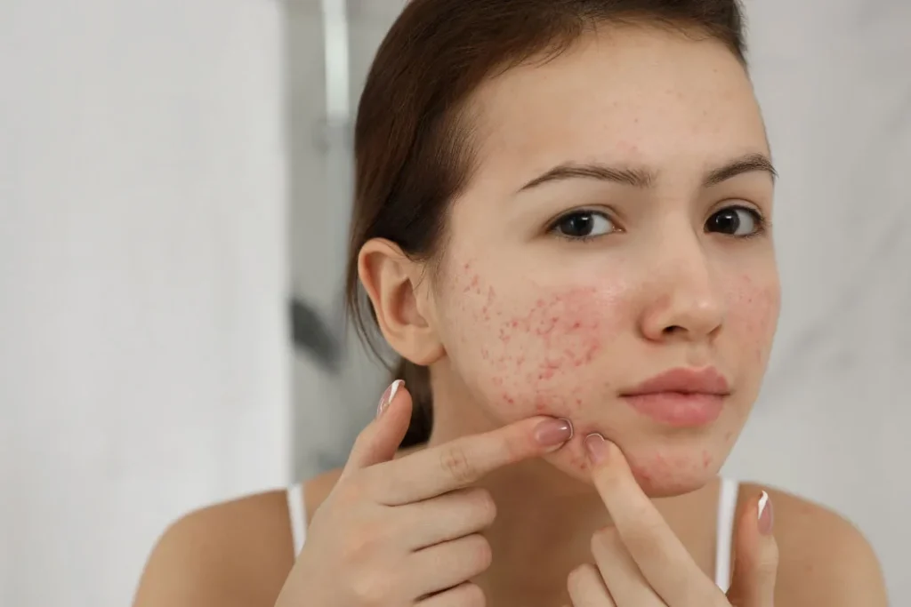 A young girl having acne on her face. 