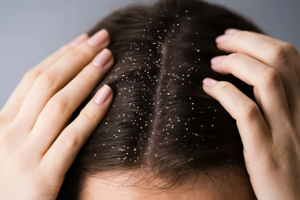 Scalp dandruff. 