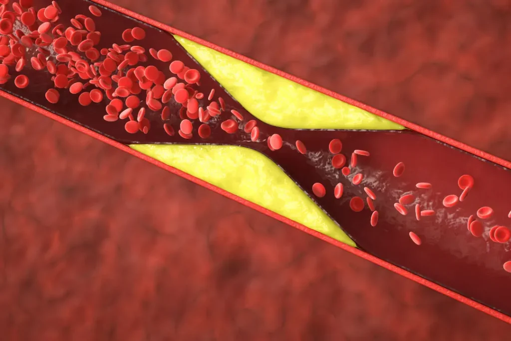 Blood vessels becoming narrow due to cholesterol. 