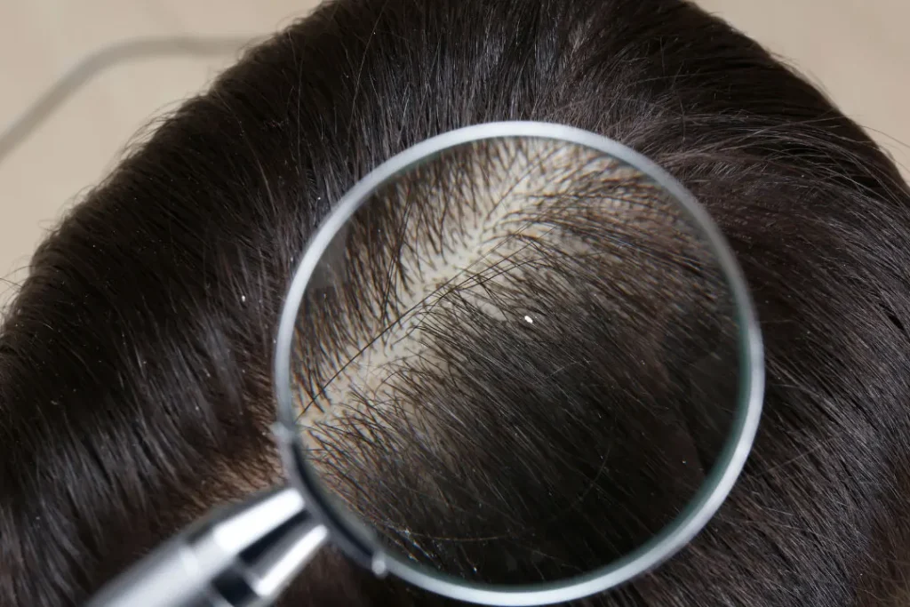 Scalp sensitivity. 